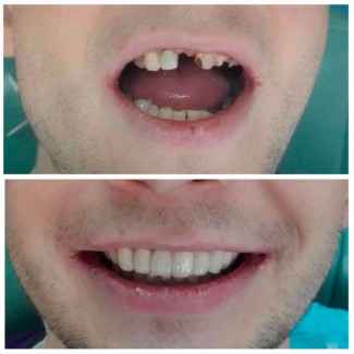 Надійне протезування зубів у місті Черкаси - безметалова кераміка