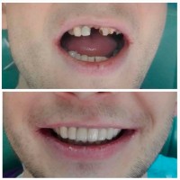 Надійне протезування зубів у місті Черкаси - безметалова кераміка