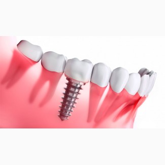 Високоякісна установка зубних імплантів у Черкасах із гарантією